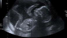 Αγγλία και Ουαλία έφτασαν σε ρεκόρ αμβλώσεων